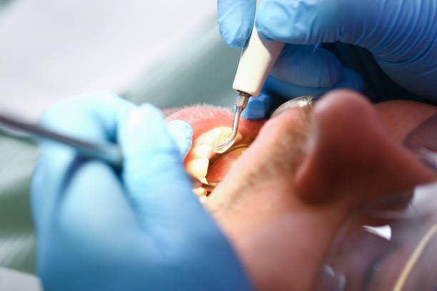 Emergency Dental Filling Replacement in OH